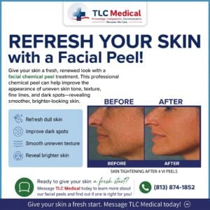 Read more about the article Facial Chemical Peel in Tampa: Refresh Your Skin with TLC Medical