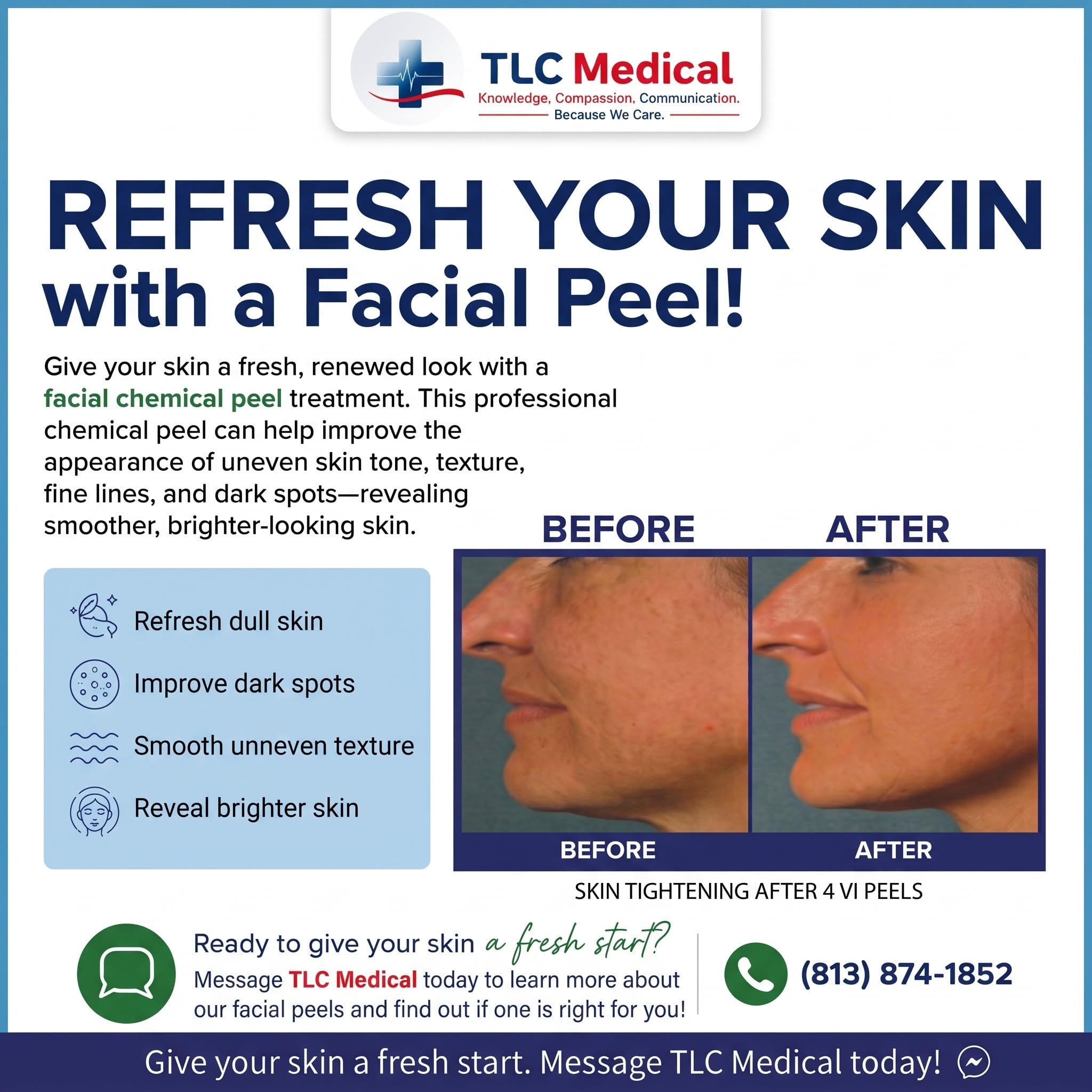 You are currently viewing Facial Chemical Peel in Tampa: Refresh Your Skin with TLC Medical