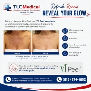 Read more about the article VI Peel in Tampa, FL: Refresh Your Skin and Reveal Your Glow