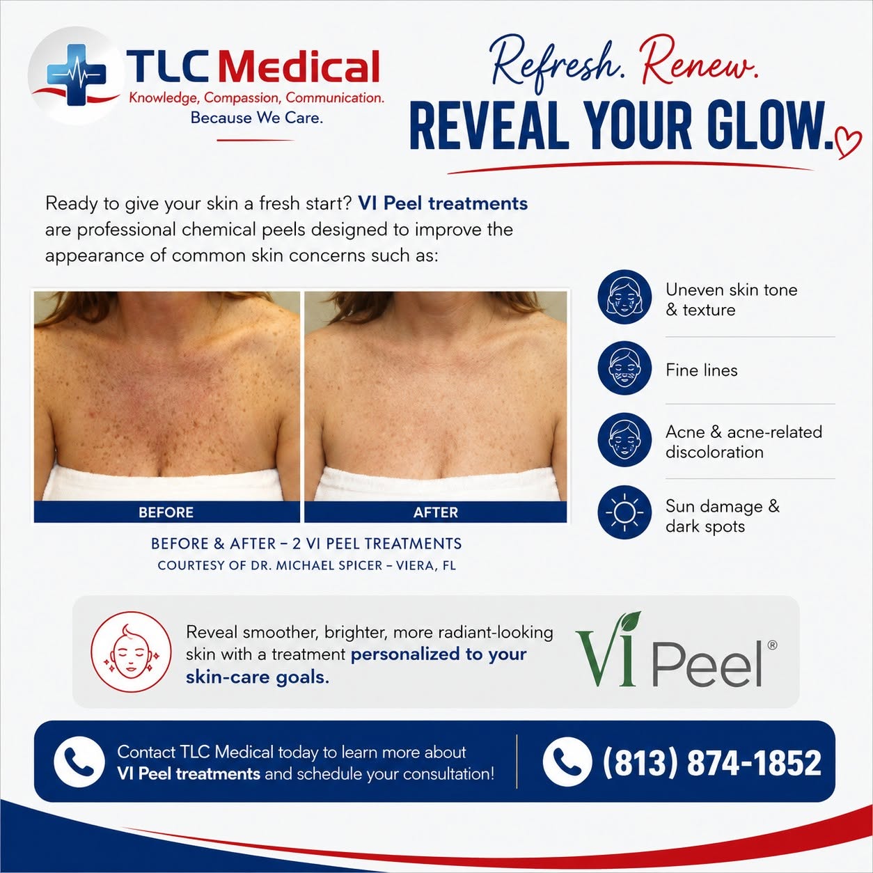 You are currently viewing VI Peel in Tampa, FL: Refresh Your Skin and Reveal Your Glow